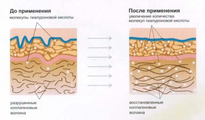 Мезотерапия в домашних условиях. результат воздействия на кожу