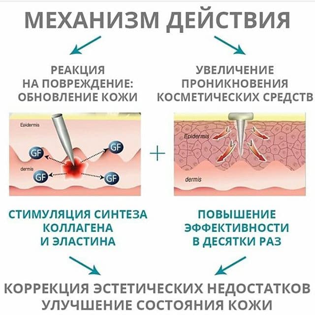 Мезотерапия в домашних условиях, механизм действия